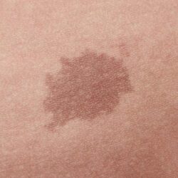 Macchie solari Melasma